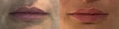 Voluma before and after photo