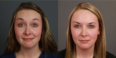 Botox before and after photo