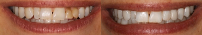 Dental Bonding before and after photo