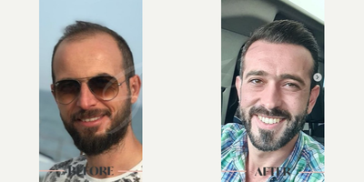 FUE Hair Transplant before and after photo
