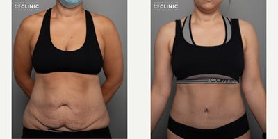 Liposuction before and after photo