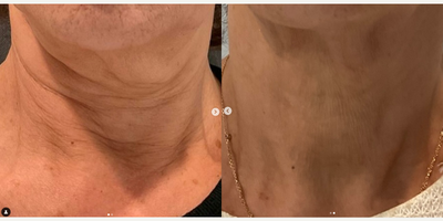 Morpheus8 before and after photo