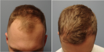 NeoGraft before and after photo