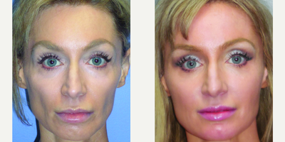 Botox before and after photo