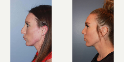 Chin Implant before and after photo