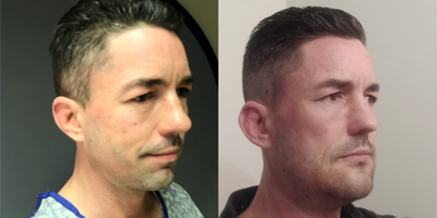 Genioplasty before and after photo