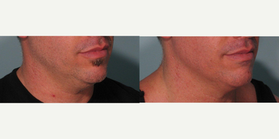 Ultherapy before and after photo