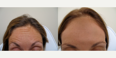 Dysport before and after photo