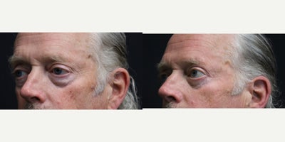 Eyelid Surgery before and after photo