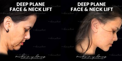 before and after image