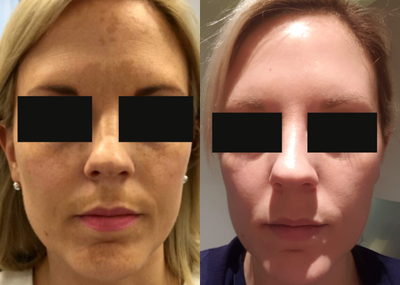 Laser Resurfacing before and after photo