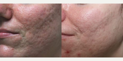 Laser Resurfacing before and after photo