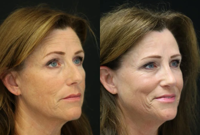 Rhinoplasty before and after photo