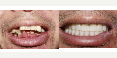 Smile Makeover before and after photo