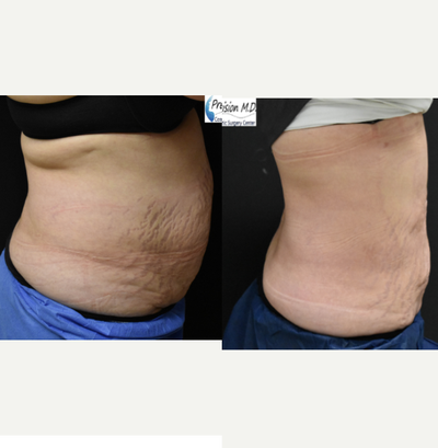 Vaser Liposuction before and after photo