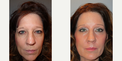 CO2 Laser before and after photo