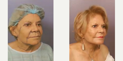Facelift before and after photo