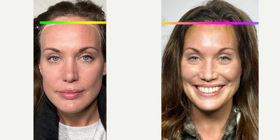 Forehead Reduction before and after photo