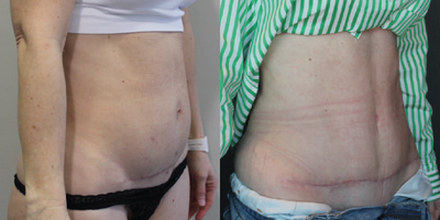 Liposuction before and after photo