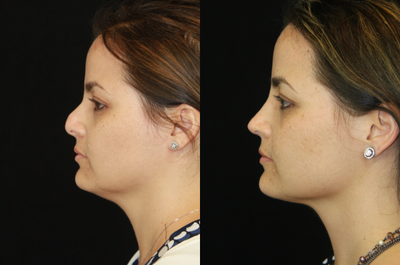 Revision Rhinoplasty before and after photo