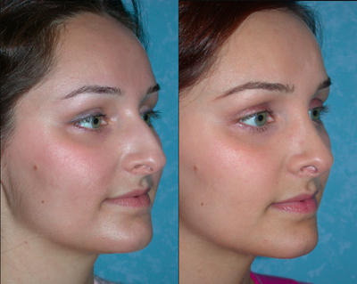 Rhinoplasty before and after photo