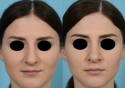 Rhinoplasty before and after photo