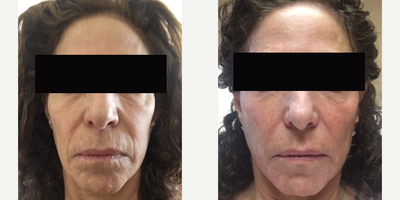 Sculptra before and after photo