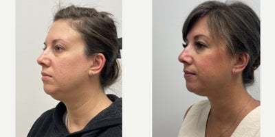Chin Liposuction before and after photo