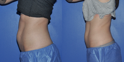 CoolSculpting before and after photo