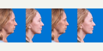 Facelift before and after photo