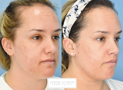 Clear and Brilliant before and after photo