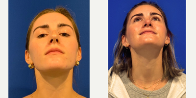Rhinoplasty before and after photo