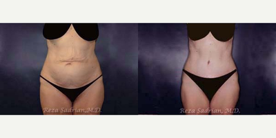 Tummy Tuck before and after photo
