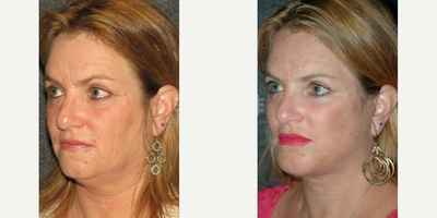 Facelift before and after photo