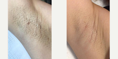 Laser Hair Removal before and after photo