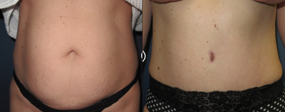 Liposuction before and after photo