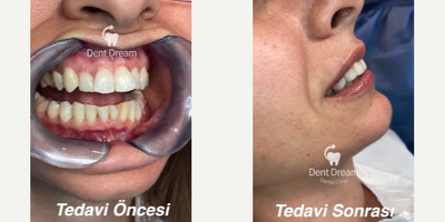 Teeth Whitening before and after photo