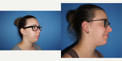 Chin Filler before and after photo