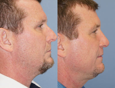 Kybella before and after photo