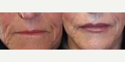 Restylane before and after photo