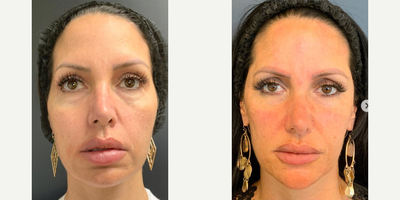 Sculptra before and after photo