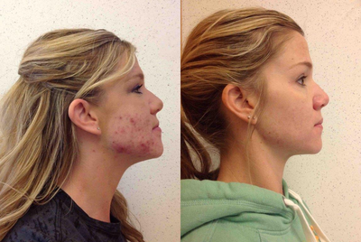 Accutane before and after photo