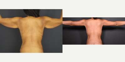 Arm Lift before and after photo