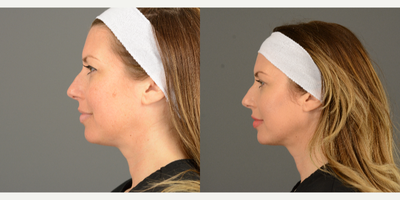 Chin Filler before and after photo