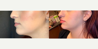Lip Fillers before and after photo