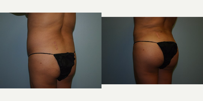 Liposuction before and after photo