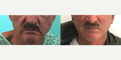 Facelift before and after photo