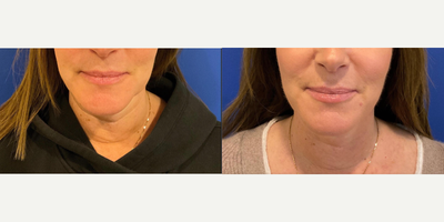 Lip Fillers before and after photo
