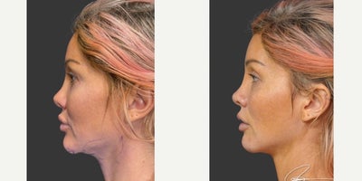 Lip Surgery before and after photo
