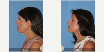 before and after image